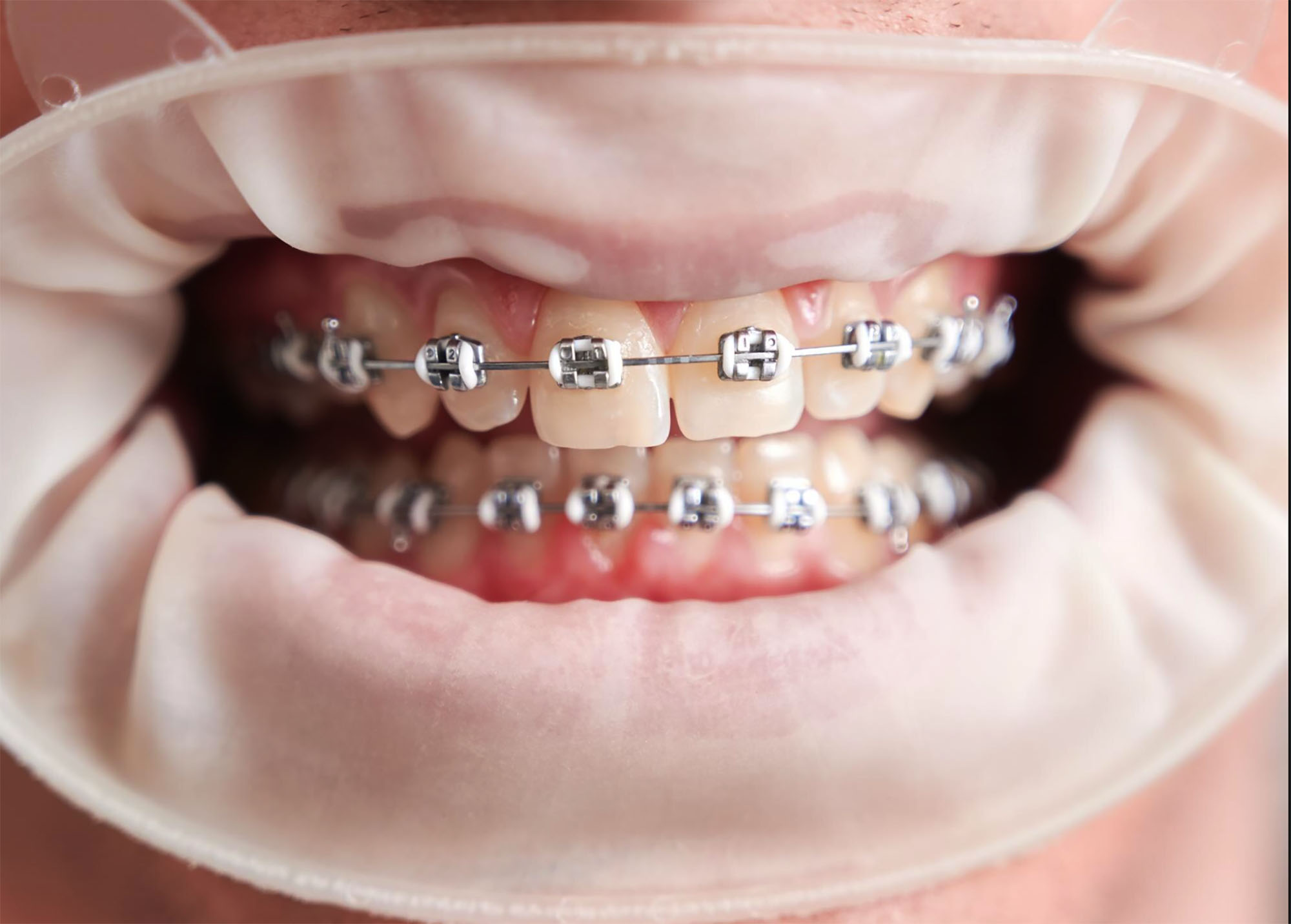 Ортодонтия в поликлинике для взрослых Москва