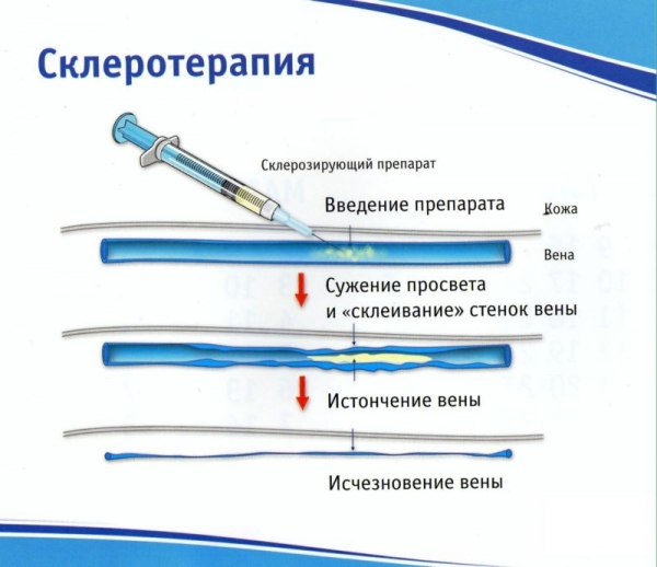 Нужно ли Удалять "Сосудистые звездочки" Врач Алексей Мареев Дзен
