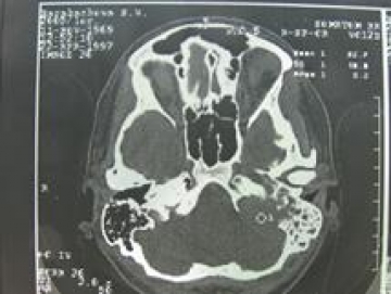 Компьютерная томография среднего и внутреннего уха с сосцевидным отростком