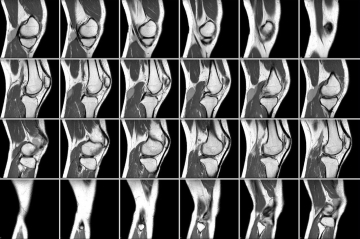 Компьютерная томография крупного сустава ( коленный, тазобедренный, плечевой, локтевой)