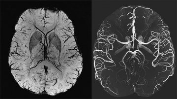 Магнитно-резонансная томография сосудов головного мозга