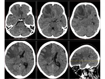 Компьютерная томография головного мозга с внутривенным контрастированием