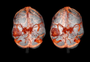 Компьютерная томография головного мозга