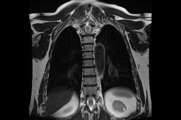 Магнитно-резонансная томография грудного отдела позвоночника