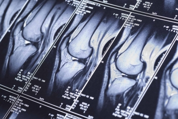 Магнитно-резонансная томография коленного сустава