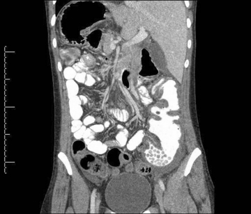 Компьютерная томография печени, поджелудочной железы, селезенки с внутривенным контрастированием